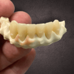 Barre implantaire titane et peek​12